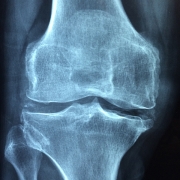 Osteoporosi