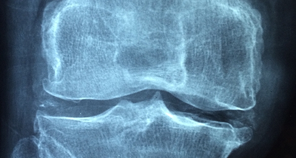 Osteoporosi